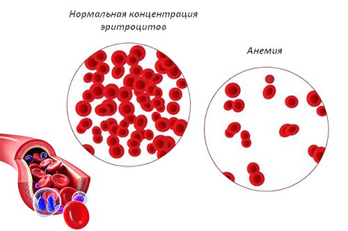 Признаки анемии у ребёнка