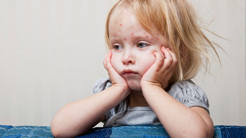 Прививка от ветрянки детям: когда и куда делают, реакция, осложнения