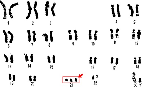 Хромосомные патологии плода: что это такое, маркеры, расшифровка