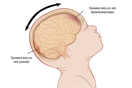 Признаки сотрясения мозга у ребенка до 1