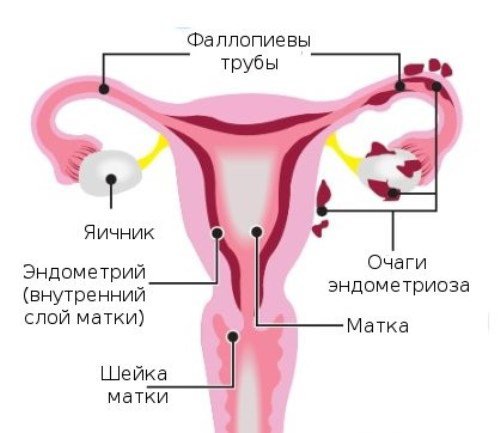 Возможна ли беременность при эндометриозе